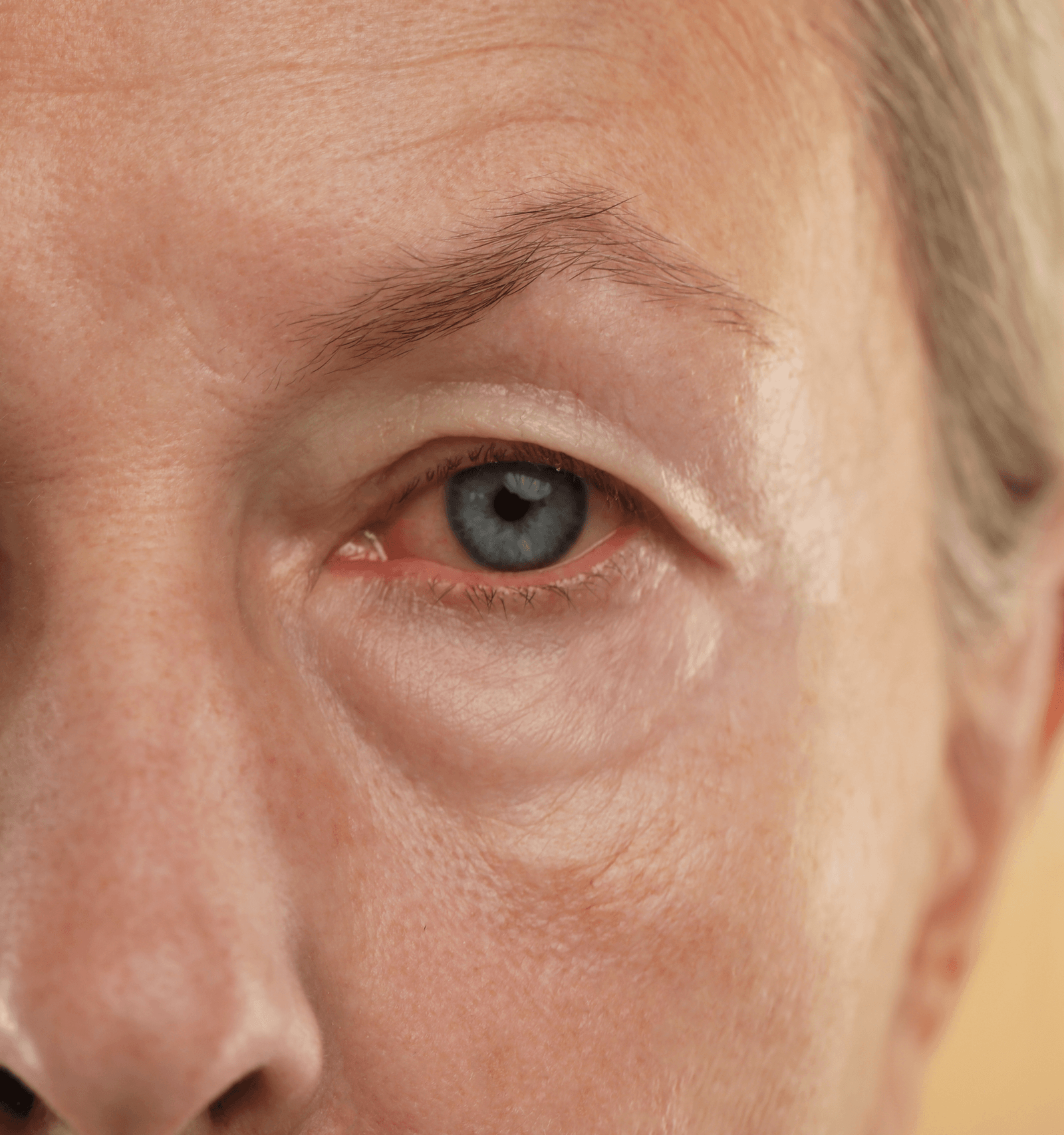 Conjunctivitis (pink eye)
