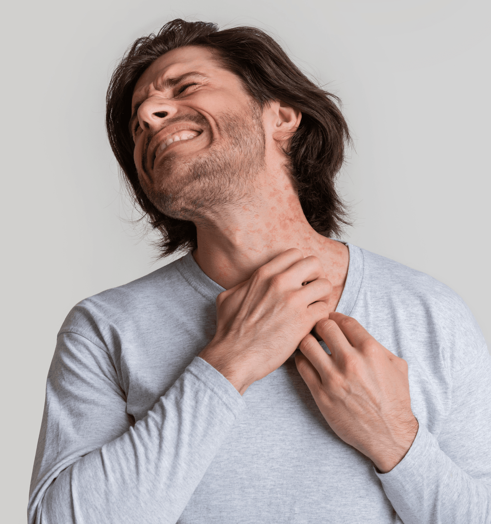 Eczema